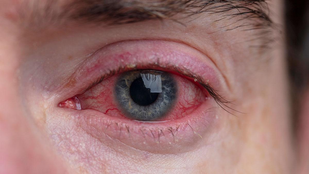 What is Conjunctivitis? Blog Image