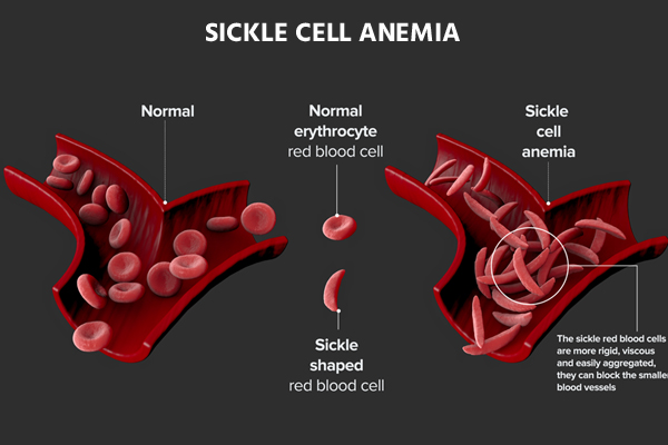 What is Sickle cell anemia? Blog Image