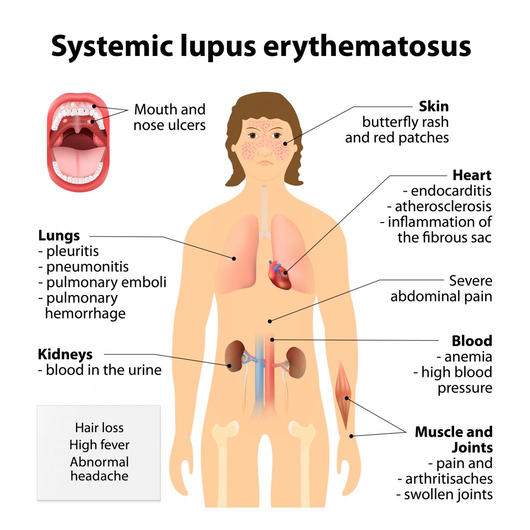 What is Lupus? Blog Image